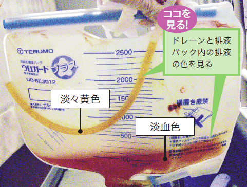 人工膀胱ケアウロガードプラスなど