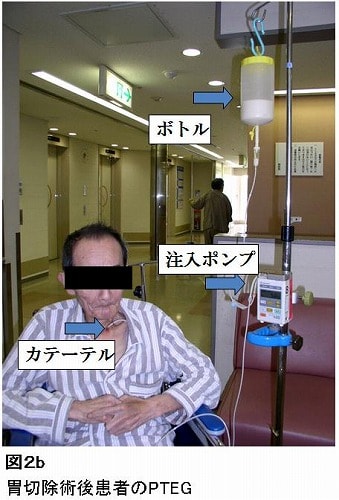 第7回 PTEGと手術的空腸瘻造設術 | ナース専科 - Part 1000
