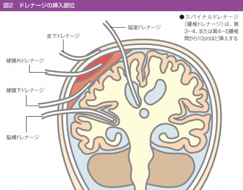 ドレナージの種類と適応 脳神経外科でドレナージが必要な理由 ナース専科