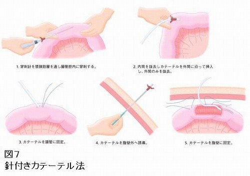 第7回 PTEGと手術的空腸瘻造設術 | ナース専科 - Part 1000